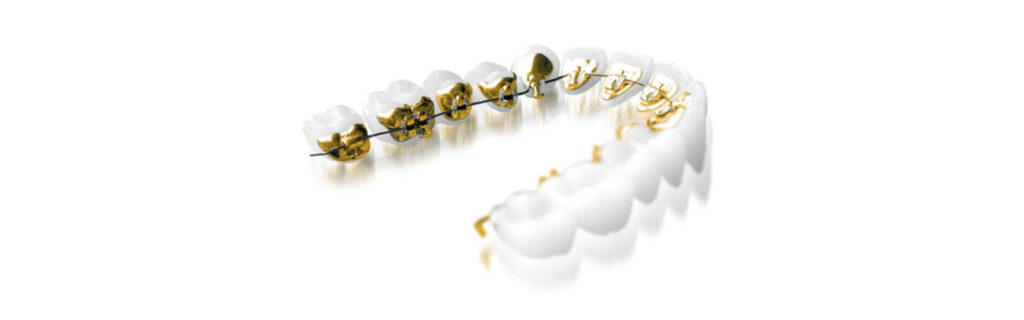 Braces Overview