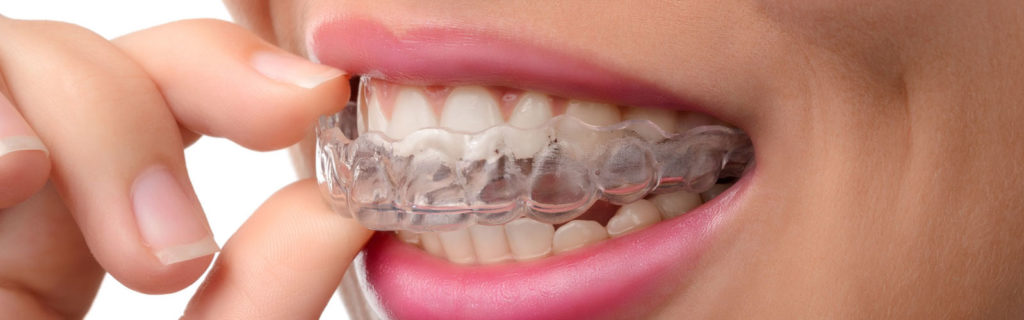 Invisalign