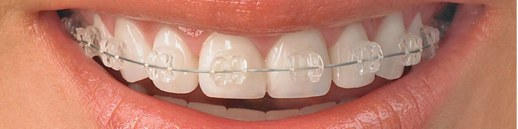 Invisalign