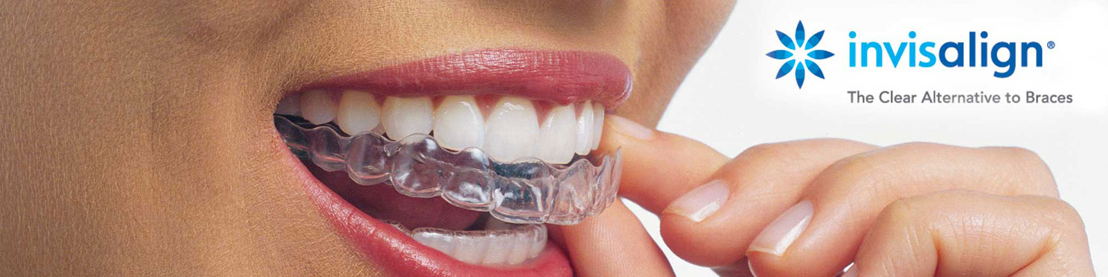 Lingual Braces