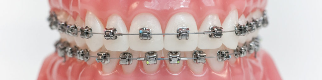 Clear Braces