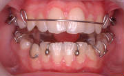 Removable Twin Block