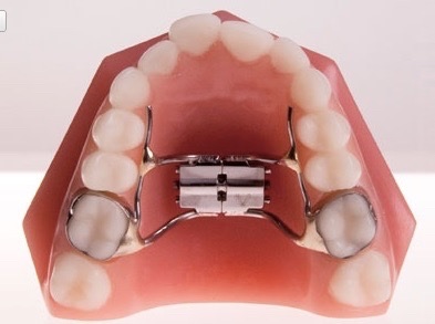 Palatal Expander