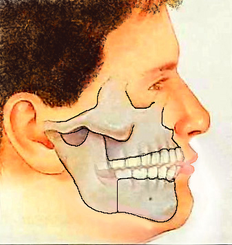 Jaw After Surgery