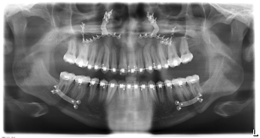Facial Surgery