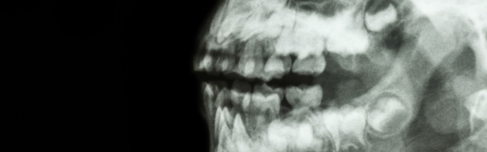 Redhead Orthodontics Orthognathic Surgery